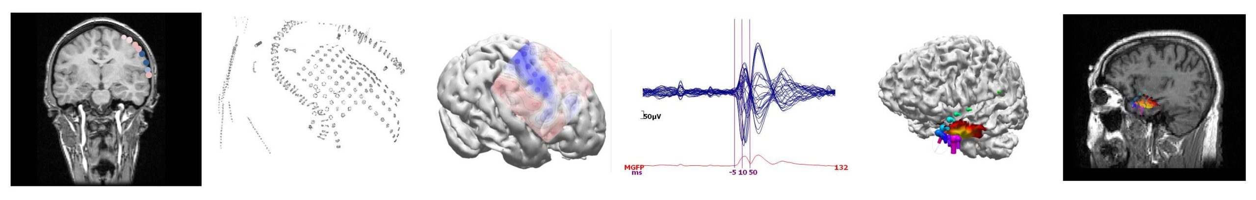 Various views on ECoG Epilepsy recordings, showing the result of the co-registration and the source analysis